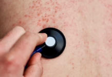 Puebla confirma segundo caso de sarampión; se trata de un menor de 8 años