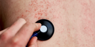 Puebla confirma segundo caso de sarampión; se trata de un menor de 8 años