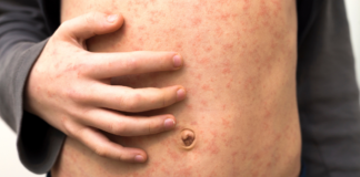 OPS ubica a México como epicentro del sarampión en América