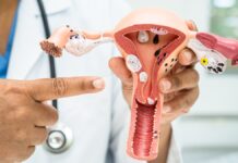 Cambia de nombre el Síndrome de Ovario Poliquístico