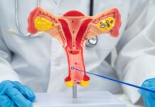 Cáncer de ovario: detectarlo a tiempo puede salvar vidas