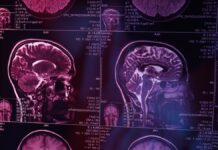 ¿Qué es lo primero que olvida una persona con Alzheimer?
