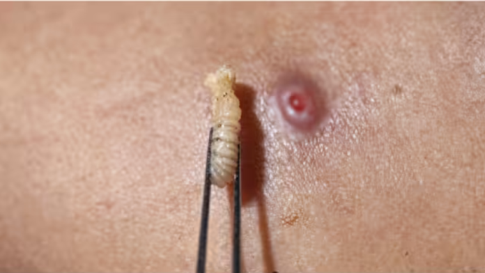 Miasis humana