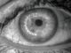 Derrame ocular podría ser señal de hipertensión o diabetes