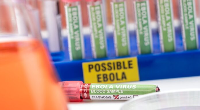 Brote de ébola en Congo supera los 5 mil casos