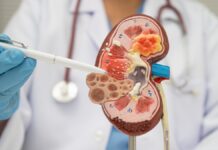 Enfermedad renal crónica puede desarrollarse durante años sin síntomas